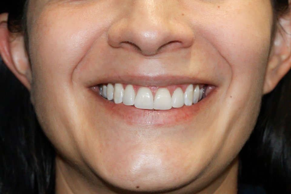 Sonrisa de frente después del tratamiento